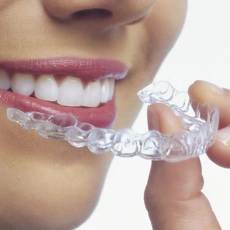 Invisible Aligners