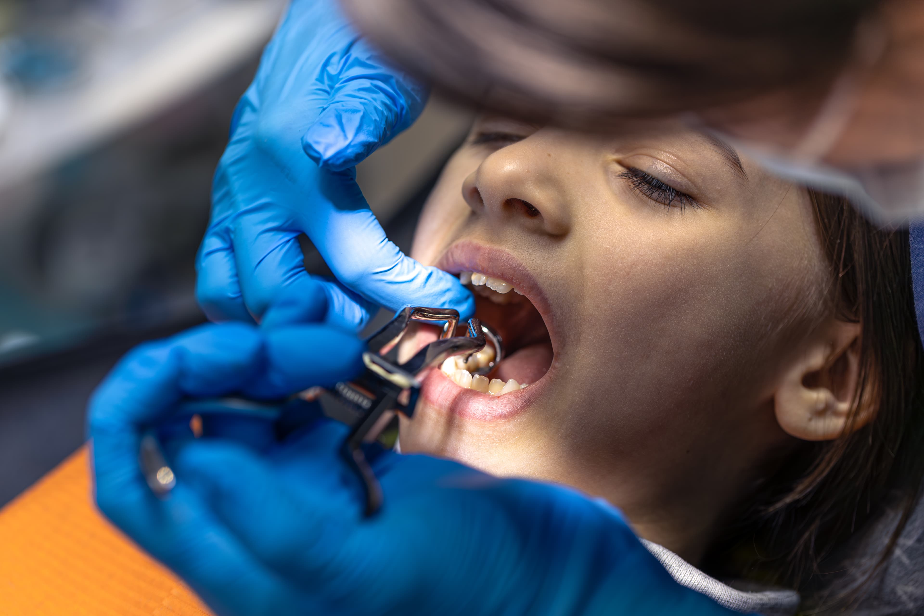 Tooth Replacement
