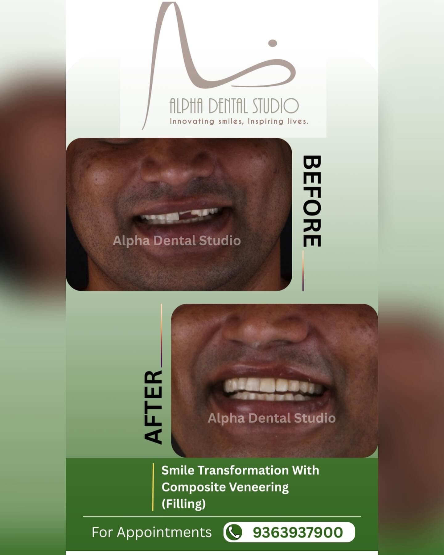 Composite veneering smile transformation before and after treatment