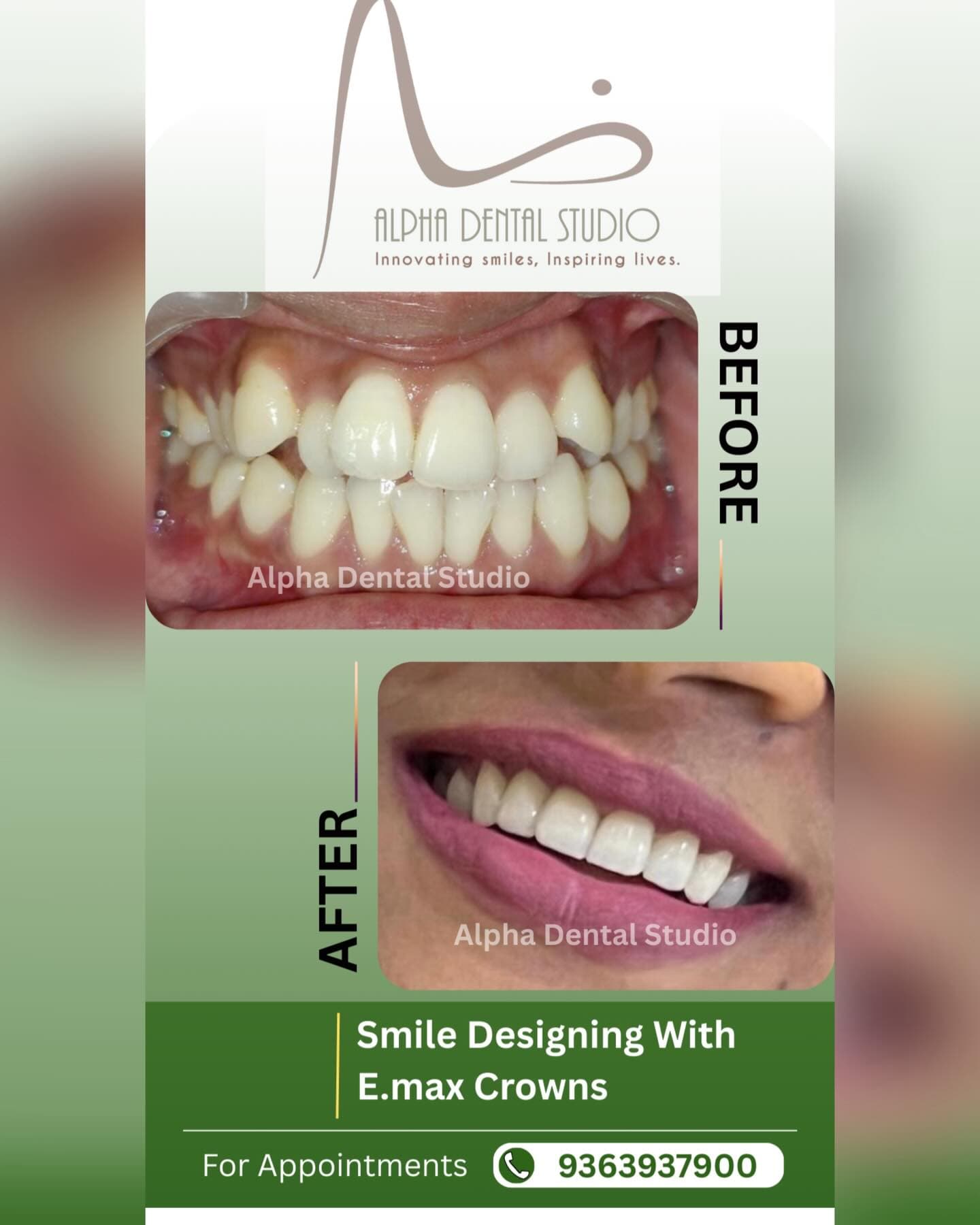 Alpha Dental Studio patient smile before and after treatment