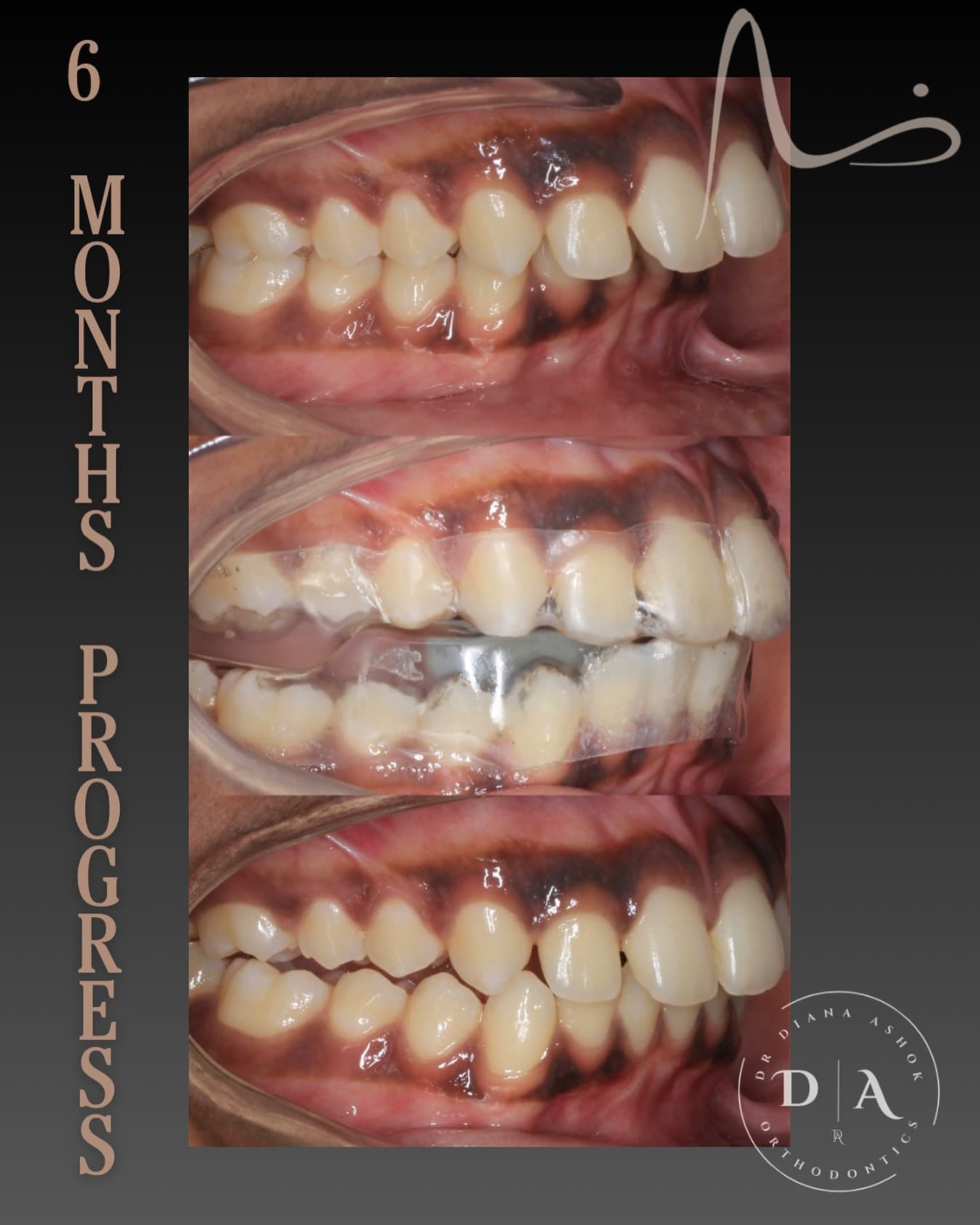 Dental smile makeover before and after treatment